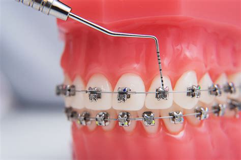 dental ortho metal dental orthodontic brackets|different types of metal brackets.